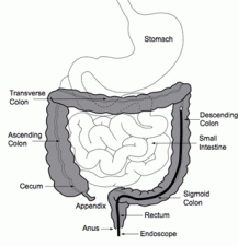 Sigmoidoscopy | Encyclopedia.com